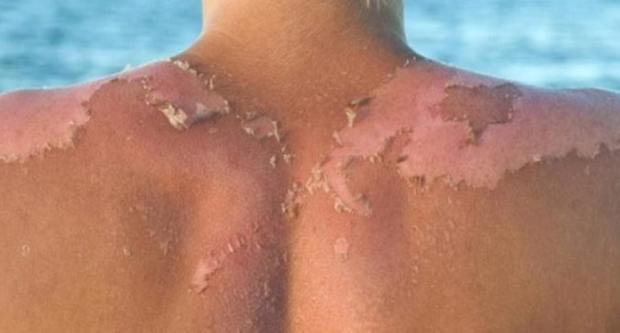 Նշվել են արեւային այրվածքի «հետաձգված» հետեւանքները