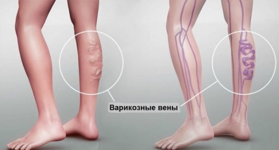 Ինչո՞ւ են շոգին սրվում այտուցներն ու վարիկոզը