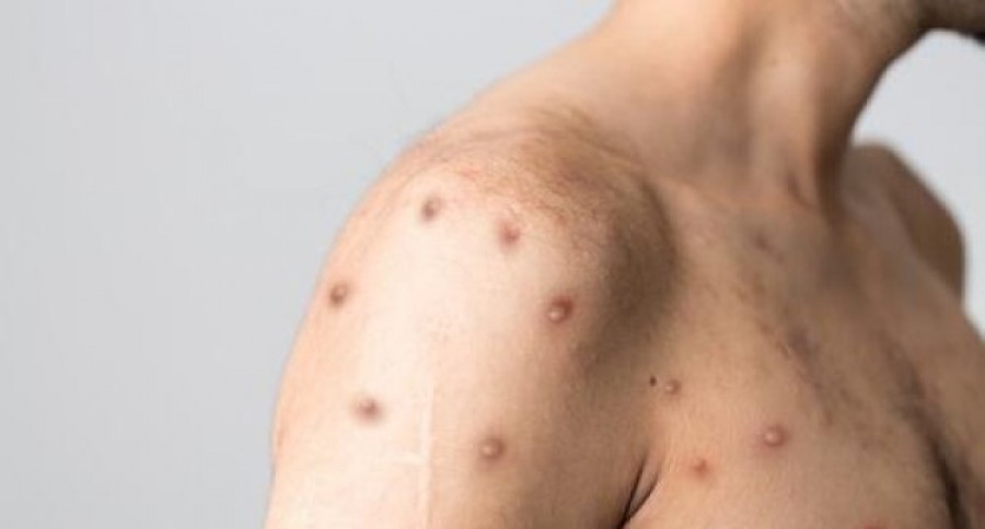 Գիտնականները հայտնաբերել են կապիկի ծաղիկի նոր կլինիկական ախտանշաններ